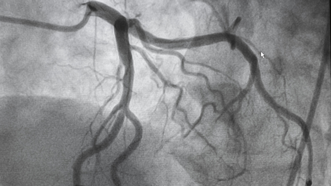 Angiography